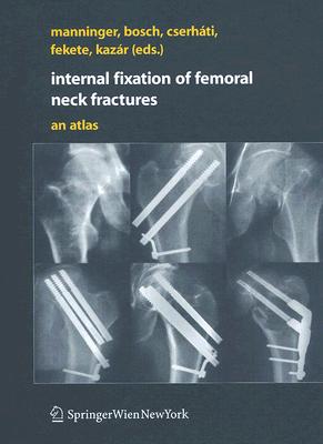 Internal fixation of femoral neck fractures: An Atlas